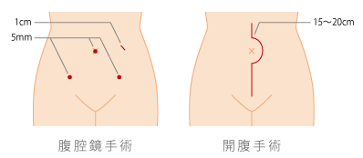 開腹手術と腹腔鏡手術